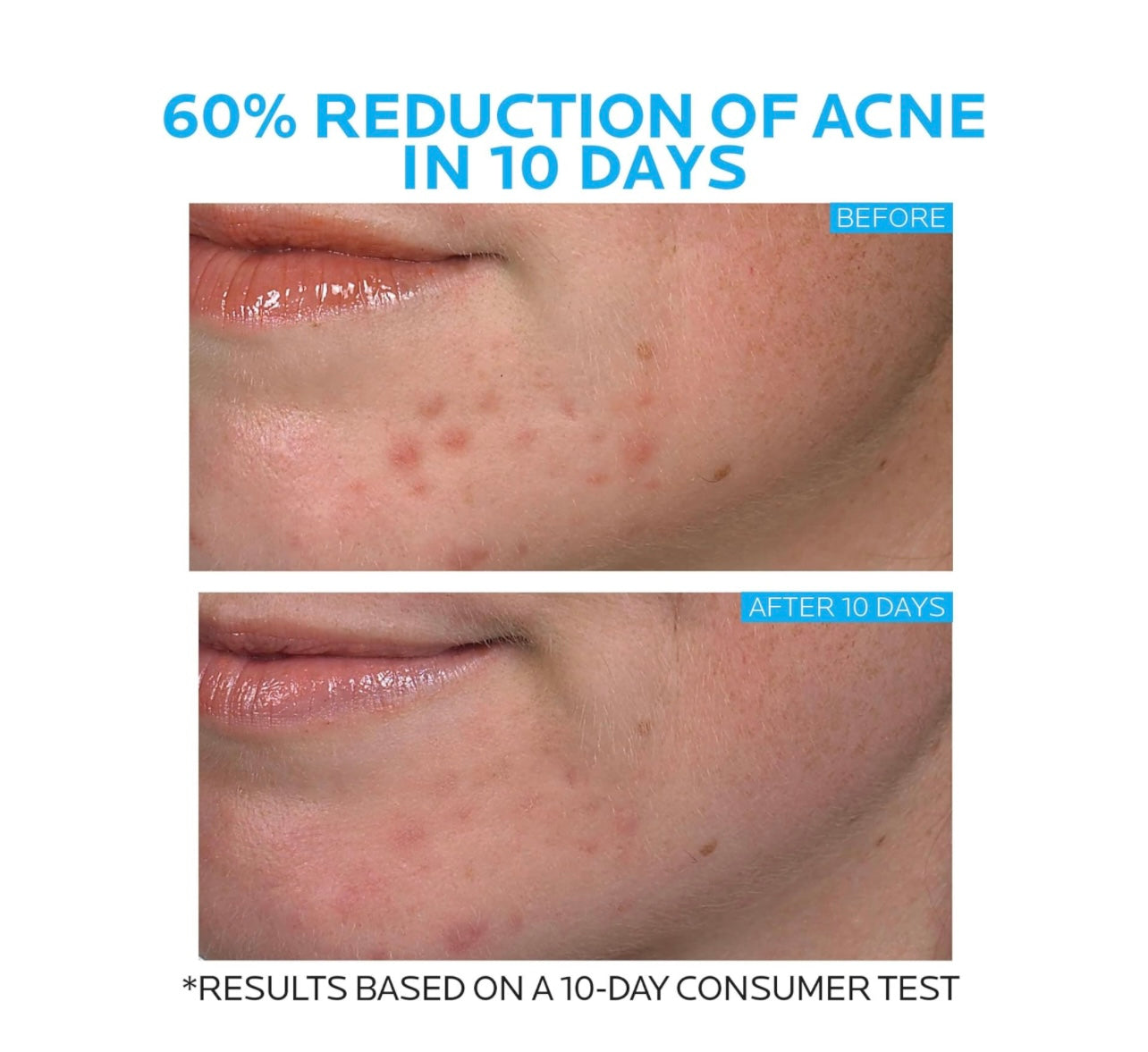 LA ROCHE-POSAY EFFACLAR DUO ACNE TREATMENT